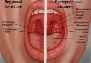 Воспаление миндалин: лечение