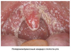 Кандидоз полости рта: лечение