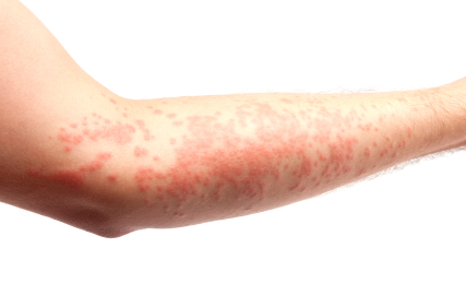 Аллергия на солнце: симптомы недуга
