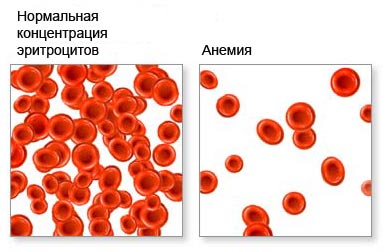 Виды анемии и варианты ее лечения