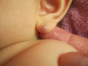 Атерома мочки уха