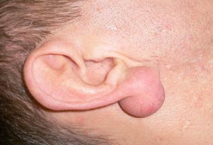 Как избавиться от атеромы мочки уха?