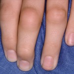 Артрит пальцев рук: диагностика и лечение