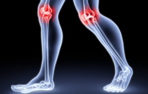 Артрит коленного сустава: симптомы и виды болезни