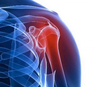 Артрит плечевого сустава: как лечить
