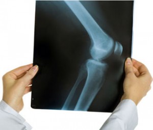 Артроз коленного сустава: симптомы