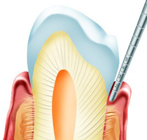 катаральная форма гиперчувствительности зубов