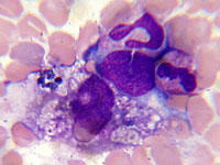 гистиоцитоз из клеток Лангерганса