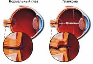 Глаз с заболеванием глаукома