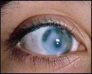 Глаз больного глаукомой