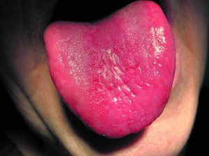 Заболевание языка глосситом
