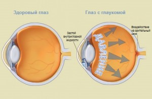 Сравнение больного и здорового глаза