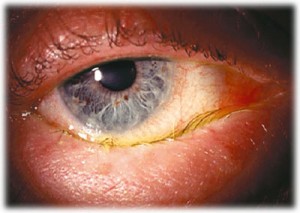 Гонорея глаз — опасное заболевание!