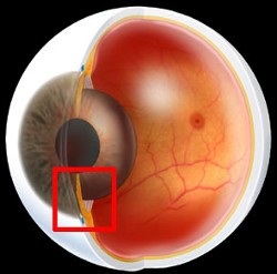 Причины, проявление и лечение скрытой глаукомы