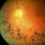 Пигментная дегенерация сетчатки глаза: есть ли шанс на улучшение?