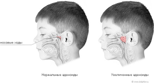 аденоиды у ребенка