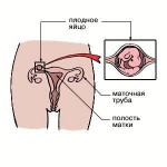 Главные признаки внематочной беременности — какие они