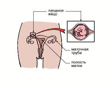 Главные признаки внематочной беременности — какие они