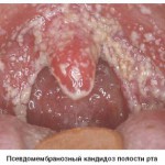 Кандидоз полости рта: лечение