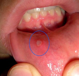 Язвы в полости рта: опасность развития, проявление симптоматики