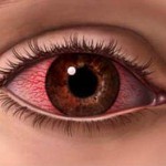 Как правильно лечить аллергию на глазах?