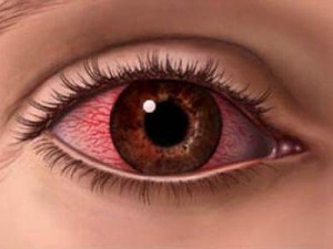 Как правильно лечить аллергию на глазах?