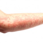 Аллергия на солнце: симптомы