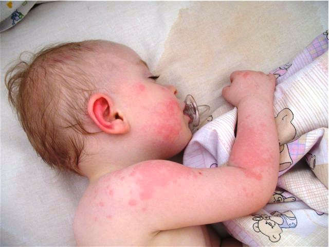 Аллергия на коже