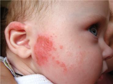 О том, как выглядит аллергия у новорожденных