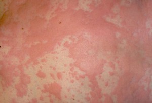Аллергия на коже: симптомы