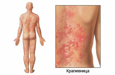 Полезные советы при лечении кожной аллергии?