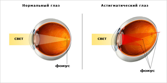 Механизм развития астигматизма глаз и основные принципы организации лечения