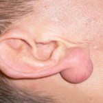 Как избавиться от атеромы мочки уха?