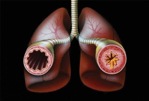 Бронхиальная астма: классификация