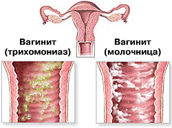 Симптомы вагинита