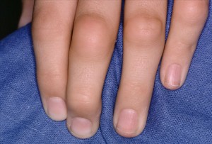 Артрит пальцев рук: диагностика и лечение