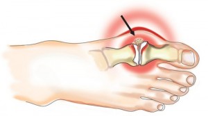 Артрит стопы: симптомы ревматоидного артрита стопы