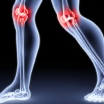 Что такое артрит коленного сустава. Симптомы проявления заболевания