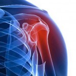 Почему развивается артрит плечевого сустава? Выбор подходящего лечения