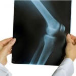 Симптомы и питание при артрозе коленного сустава