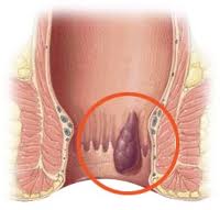 внутренний геморрой