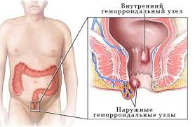 внутренний и наружний геморрой