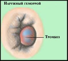 острый геморрой - тромбоз