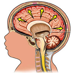Основное о внутренней гидроцефалии головного мозга. Виды и проявления
