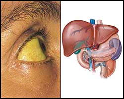 Виды и признаки гепатитной болезни