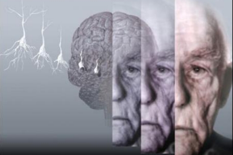 Как приостановить развитие болезни Альцгеймера?