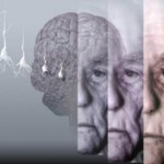 Как приостановить развитие болезни Альцгеймера?