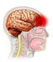 Симптомы и лечение гипертензии головного мозга