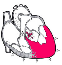 увеличения левого желудочка сердца