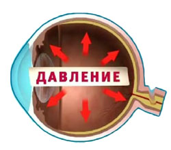 Разновидности и симптомы глаукомы глаза